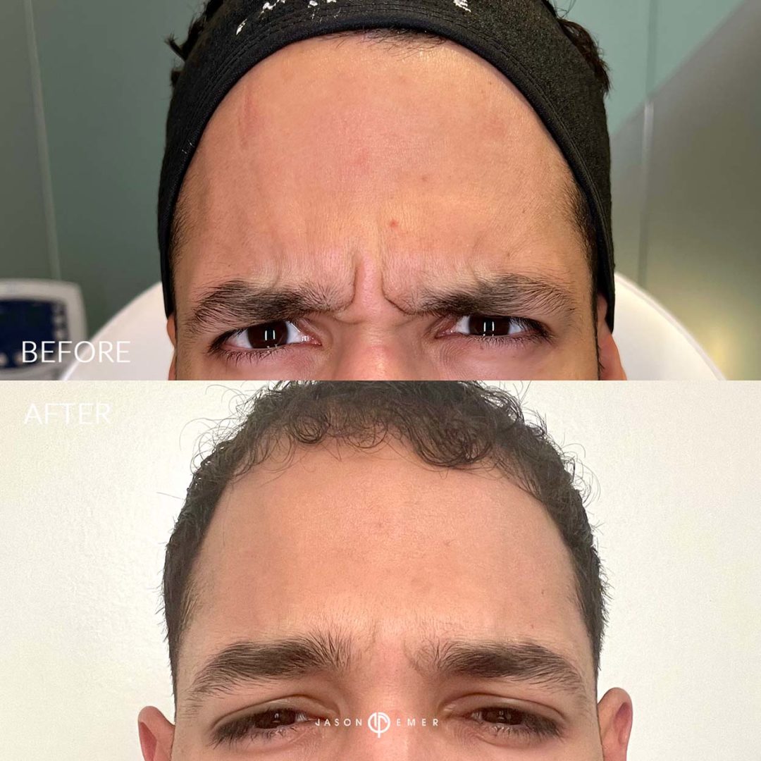 Botox Before and After Photo by Dr. Emer and Dr. Sanan in West Hollywood California