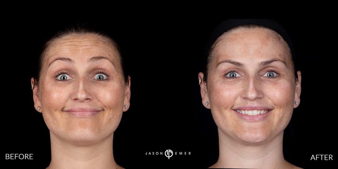 Botox Before and After Photo by Dr. Emer and Dr. Sanan in West Hollywood California