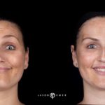 Botox Before and After Photo by Dr. Emer and Dr. Sanan in West Hollywood California