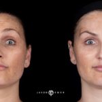 Botox Before and After Photo by Dr. Emer and Dr. Sanan in West Hollywood California