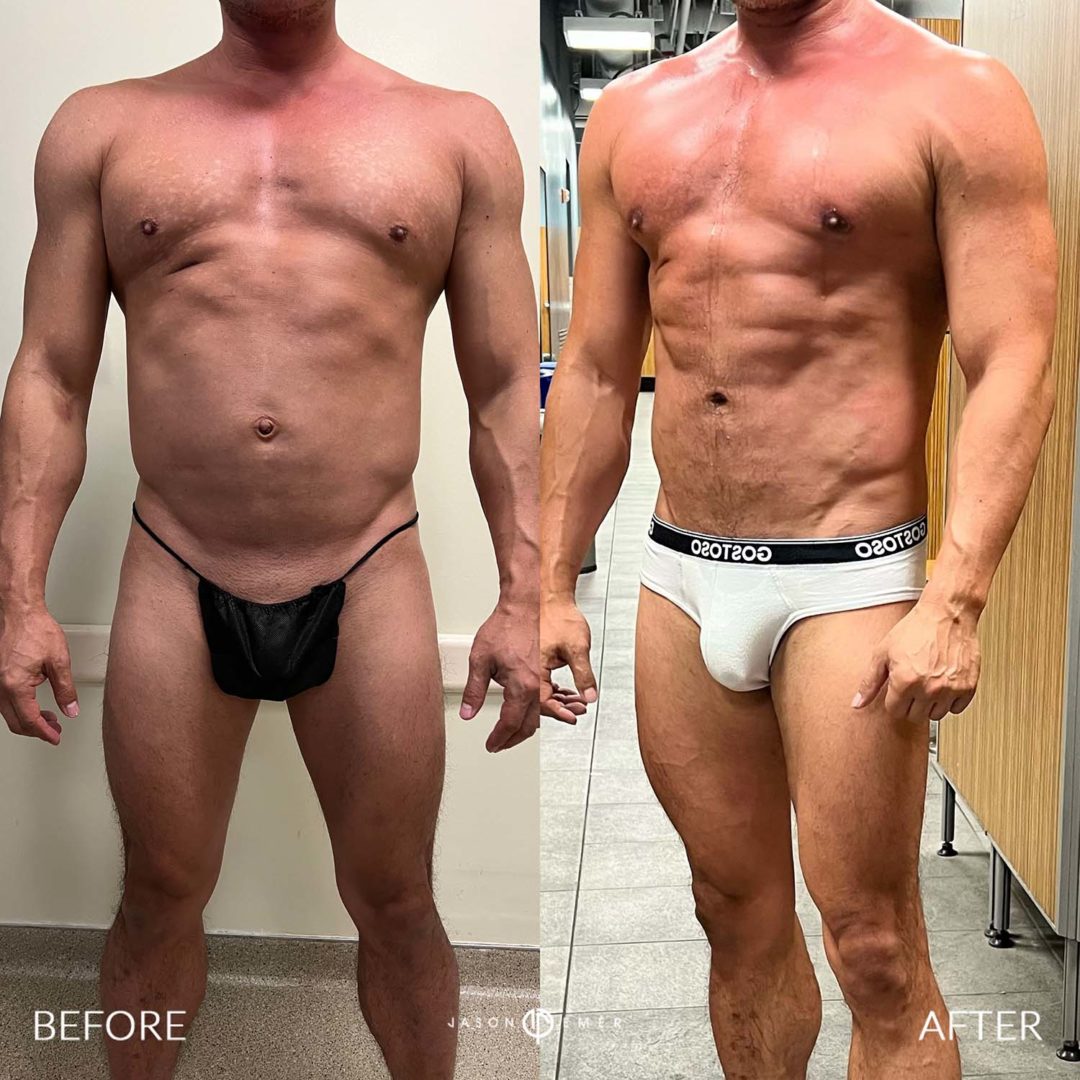 Full Male Gladiator Lipo Before and After Photo by Dr. Emer and Dr. Sanan in West Hollywood California