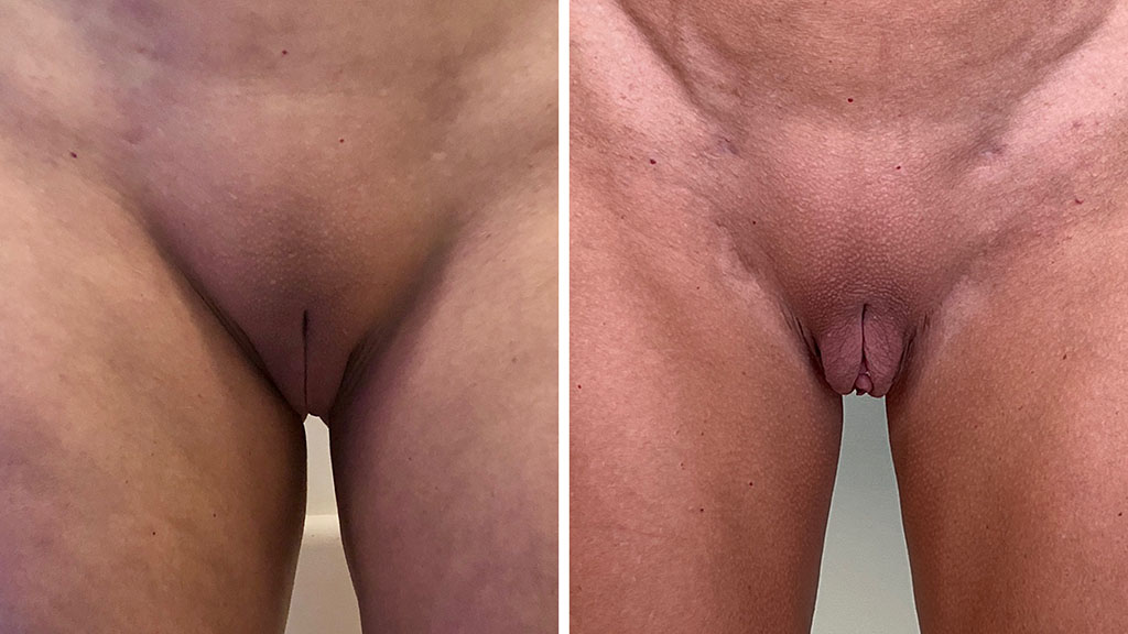 Spiral Thigh Lift Before and After Photo by Dr. Emer and Dr. Sanan in West Hollywood California