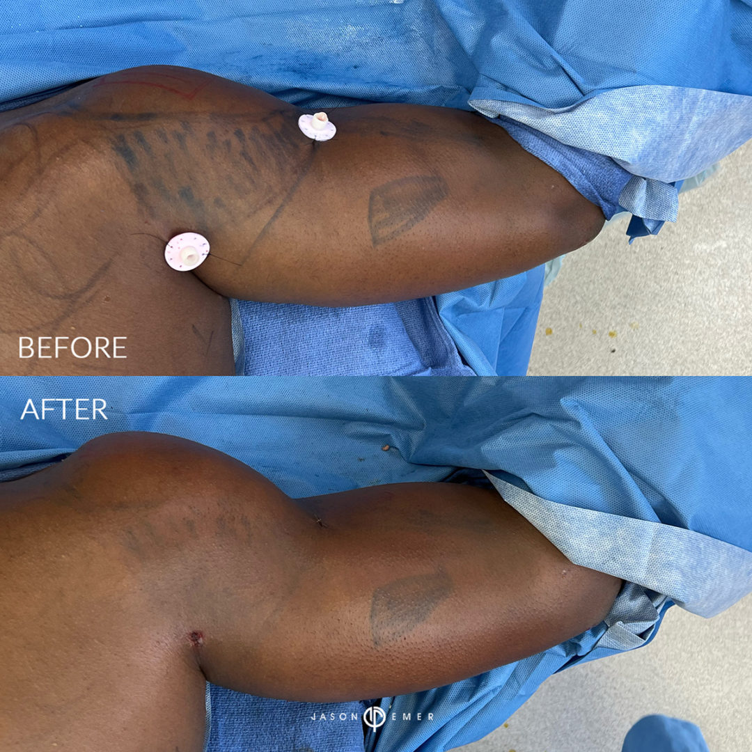 Arms Before and After Photo by Dr. Emer in West Hollywood California