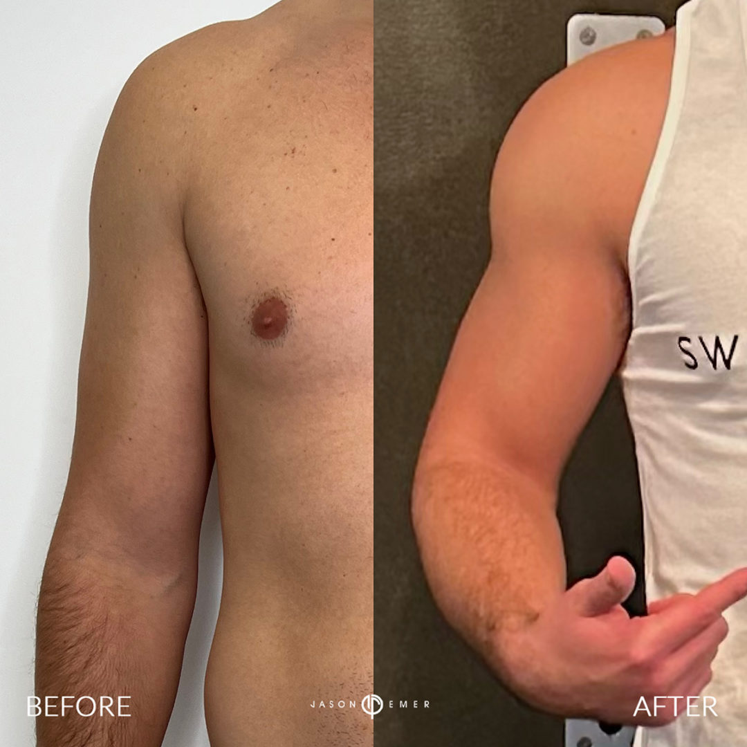 Arms Before and After Photo by Dr. Emer in West Hollywood California