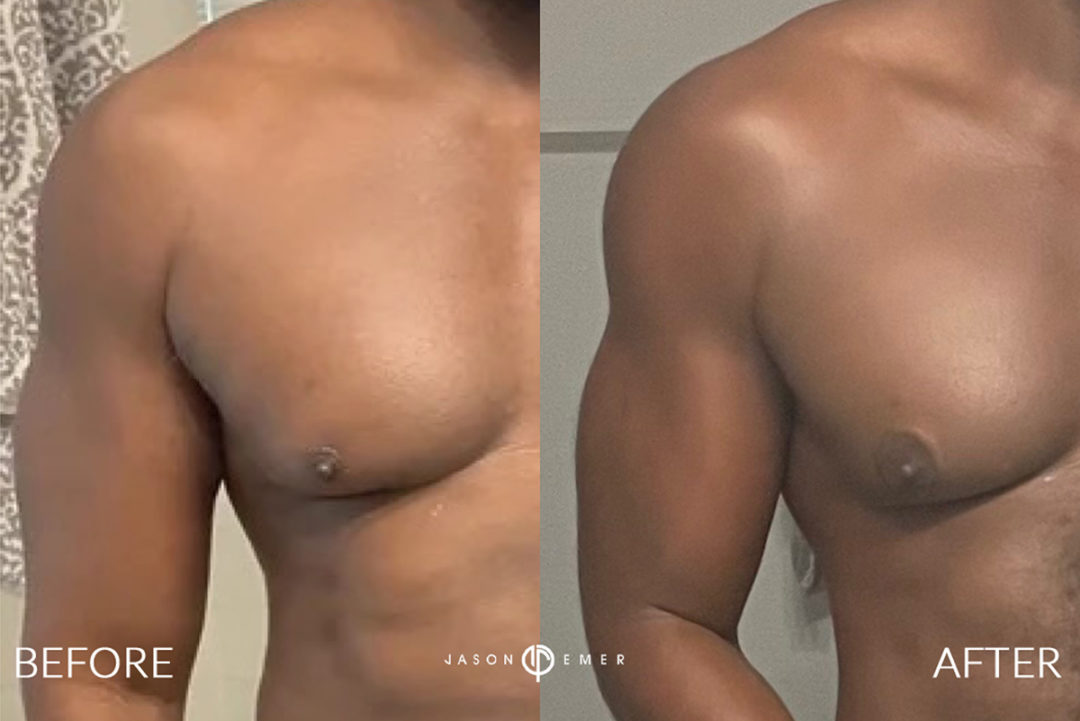 Arms Before and After Photo by Dr. Emer in West Hollywood California