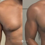 Arms Before and After Photo by Dr. Emer in West Hollywood California