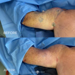 Arms Before and After Photo by Dr. Emer in West Hollywood California