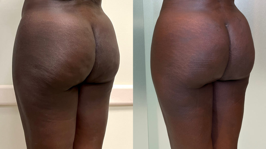 Aveli Before and After Photo by Dr. Emer in West Hollywood California