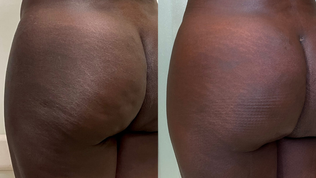 Aveli Before and After Photo by Dr. Emer in West Hollywood California