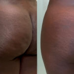 Aveli Before and After Photo by Dr. Emer in West Hollywood California