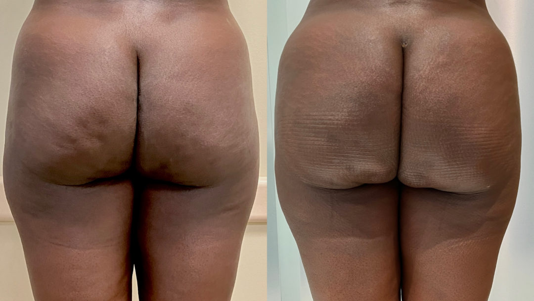 Aveli Before and After Photo by Dr. Emer in West Hollywood California