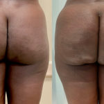 Aveli Before and After Photo by Dr. Emer in West Hollywood California