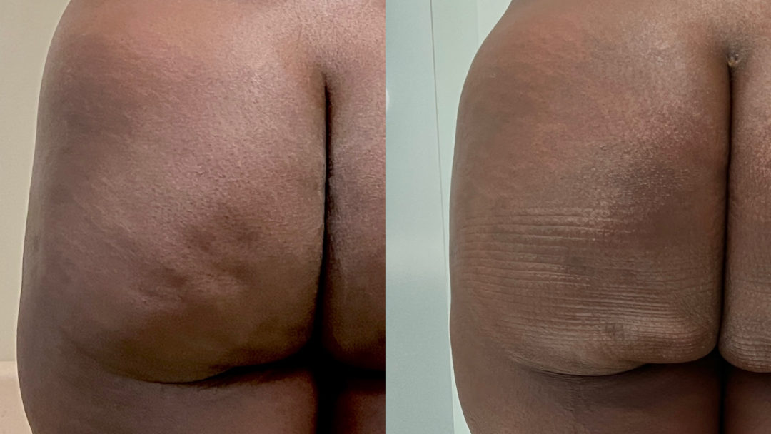 Aveli Before and After Photo by Dr. Emer in West Hollywood California