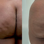 Aveli Before and After Photo by Dr. Emer in West Hollywood California