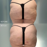 Aveli Before and After Photo by Dr. Emer in West Hollywood California