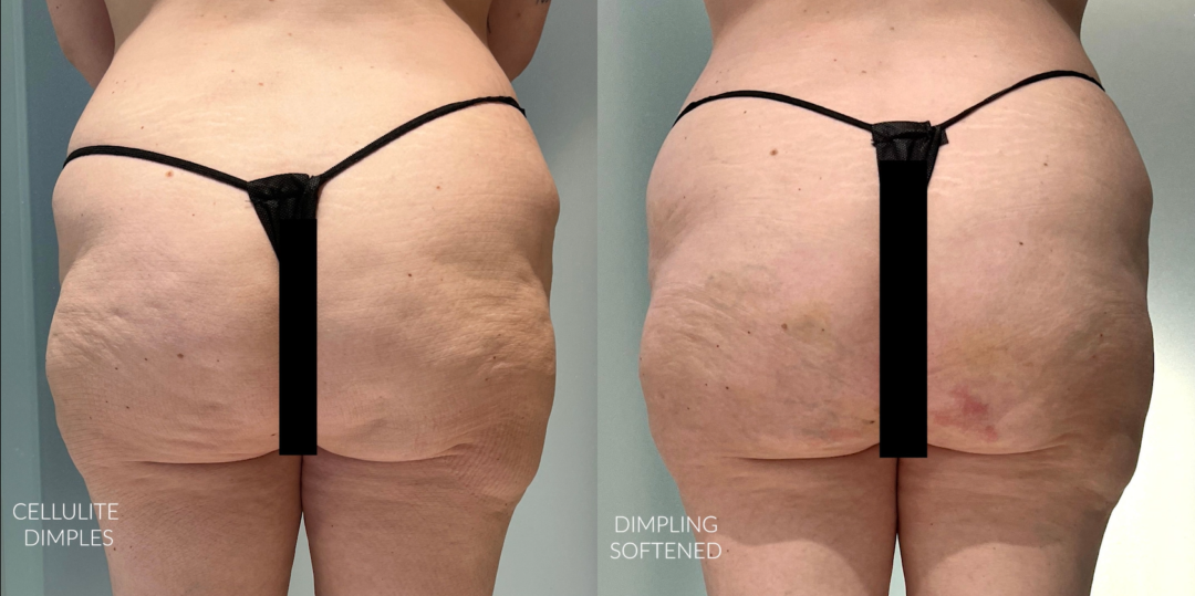 Aveli Before and After Photo by Dr. Emer in West Hollywood California