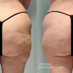 Aveli Before and After Photo by Dr. Emer in West Hollywood California