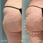 Aveli Before and After Photo by Dr. Emer in West Hollywood California