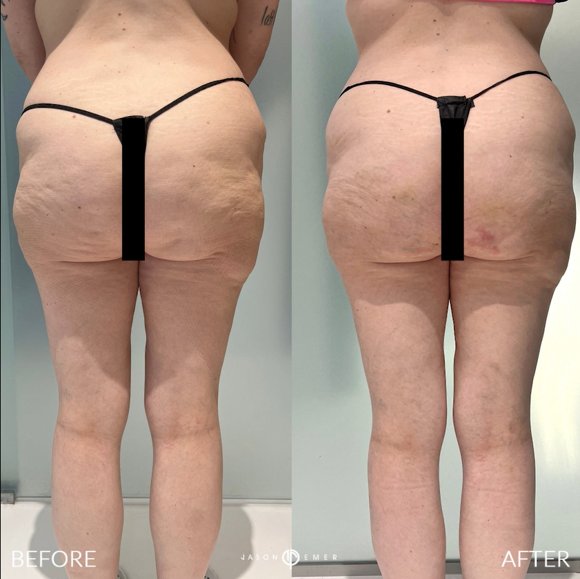 Aveli Before and After Photo by Dr. Emer in West Hollywood California