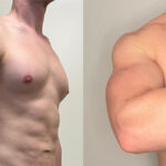 HD Lipo Arms Before and After Photo by Dr. Emer in West Hollywood California