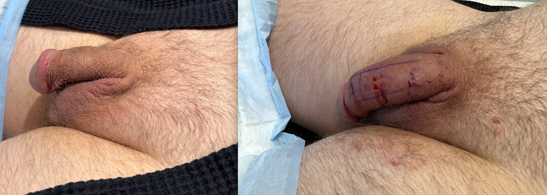 Penile Filler Before and After Photo by Dr. Emer in West Hollywood California