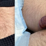 Penile Filler Before and After Photo by Dr. Emer in West Hollywood California