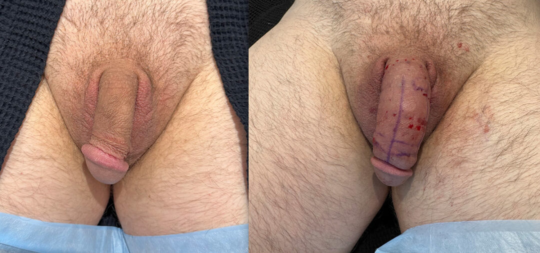 Penile Filler Before and After Photo by Dr. Emer in West Hollywood California