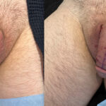 Penile Filler Before and After Photo by Dr. Emer in West Hollywood California