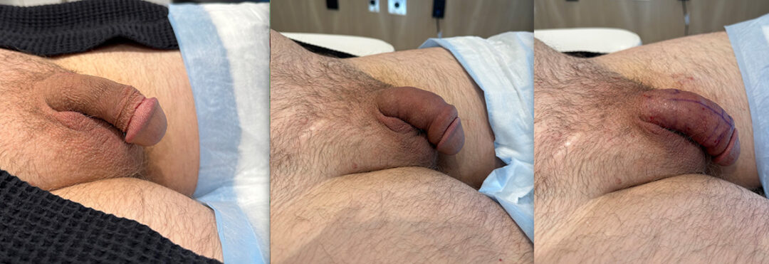 Penile Filler Before and After Photo by Dr. Emer in West Hollywood California