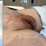 Penile Filler Before and After Photo by Dr. Emer in West Hollywood California