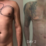 Chest Implants Before and After Photo by Dr. Emer in West Hollywood California