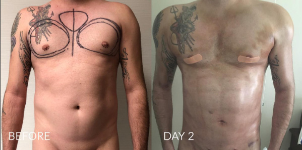 Chest Implants Before and After Photo by Dr. Emer in West Hollywood California