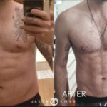 Chest Implants Before and After Photo by Dr. Emer in West Hollywood California