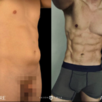 Fat grafting to Chest Before and After Photo by Dr. Emer in West Hollywood California