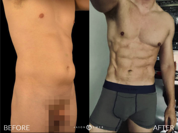 Fat grafting to Chest Before and After Photo by Dr. Emer in West Hollywood California