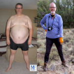 Gastric Sleeve Before and After Photo by Dr. Feiz in West Hollywood California