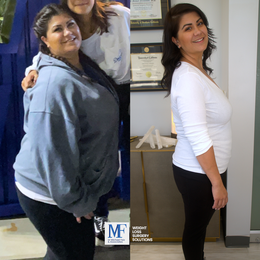 Gastric Sleeve Before and After Photo by Dr. Feiz in West Hollywood California