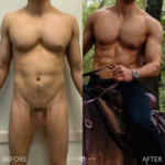 Male HD Lipo Before and After Photo by Dr. Emer in West Hollywood California