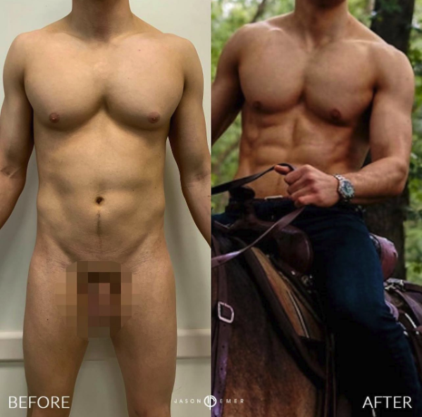 Male HD Lipo Before and After Photo by Dr. Emer in West Hollywood California