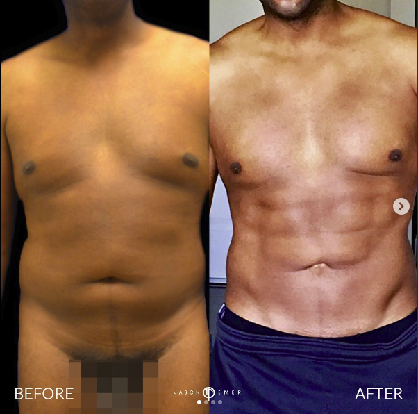 Male-Revision Lipo Before and After Photo by Dr. Emer in West Hollywood California