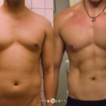 HD Lipo Before and After Photo by Dr. Emer in West Hollywood California