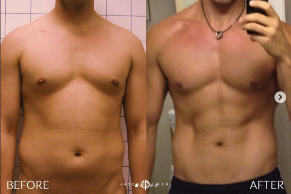 HD Lipo Before and After Photo by Dr. Emer in West Hollywood California