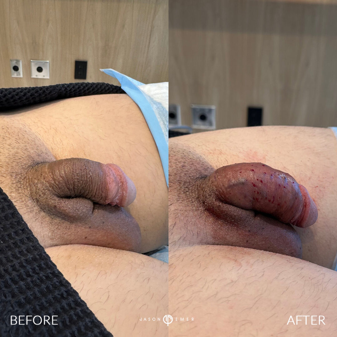 Penile Filler Before and After Photo by Dr. Emer in West Hollywood California