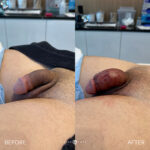 Penile Filler Before and After Photo by Dr. Emer in West Hollywood California