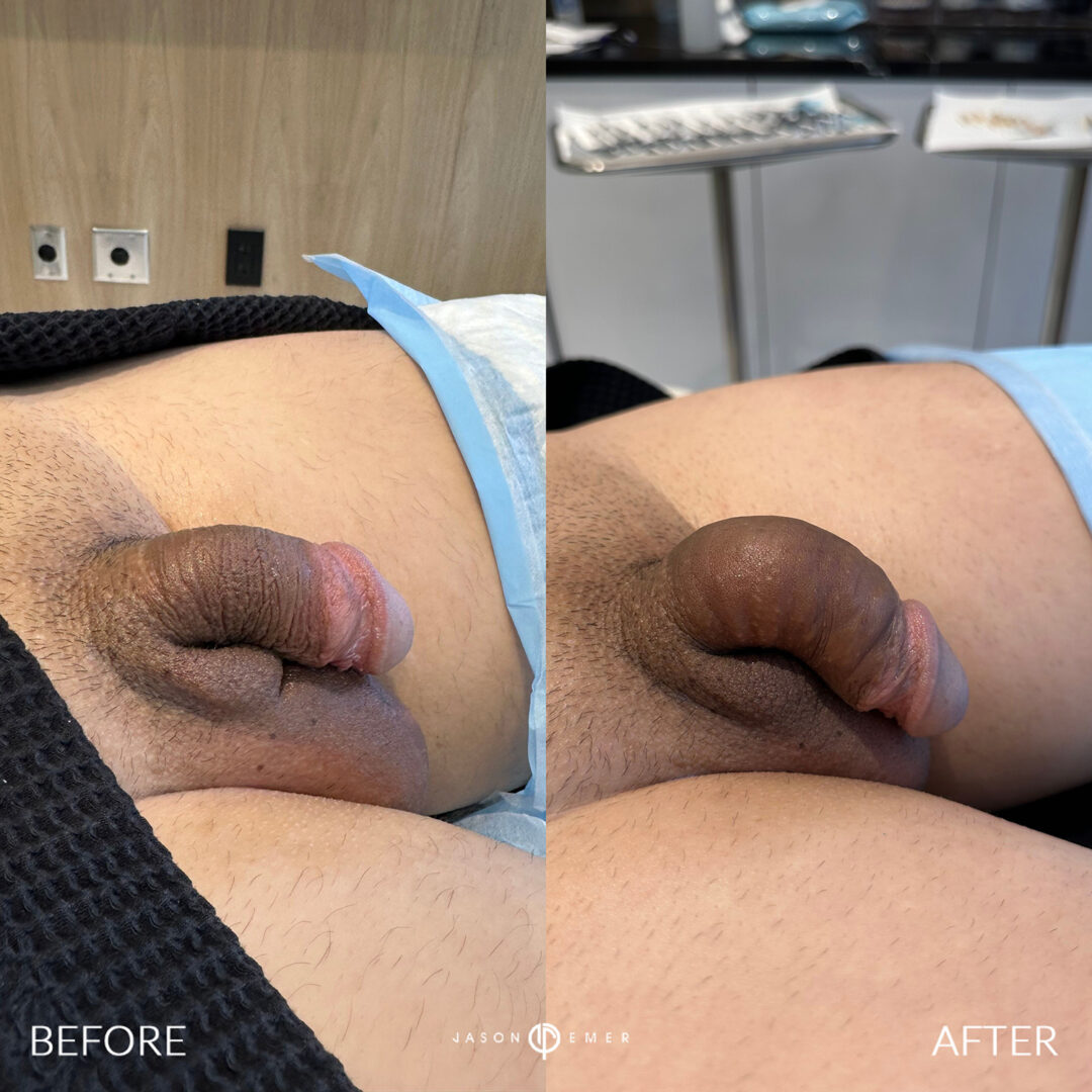 Penile Filler Before and After Photo by Dr. Emer in West Hollywood California