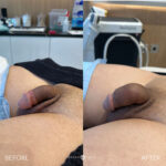 Penile Filler Before and After Photo by Dr. Emer in West Hollywood California