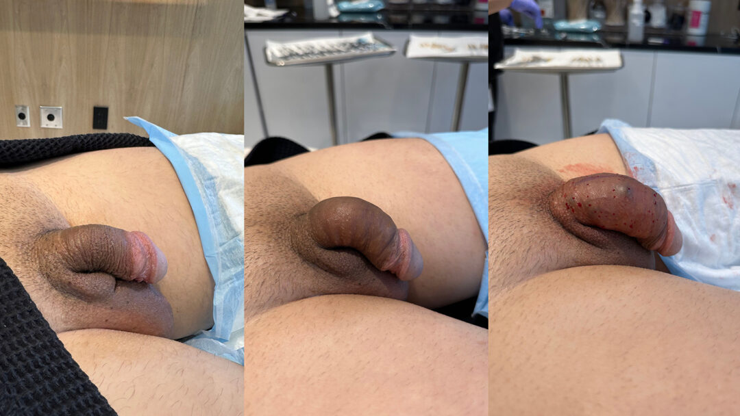 Penile Filler Before and After Photo by Dr. Emer in West Hollywood California