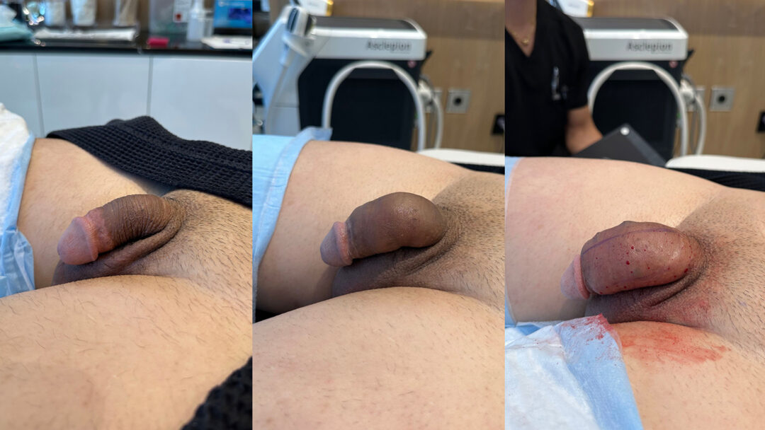 Penile Filler Before and After Photo by Dr. Emer in West Hollywood California