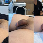 Penile Filler Before and After Photo by Dr. Emer in West Hollywood California