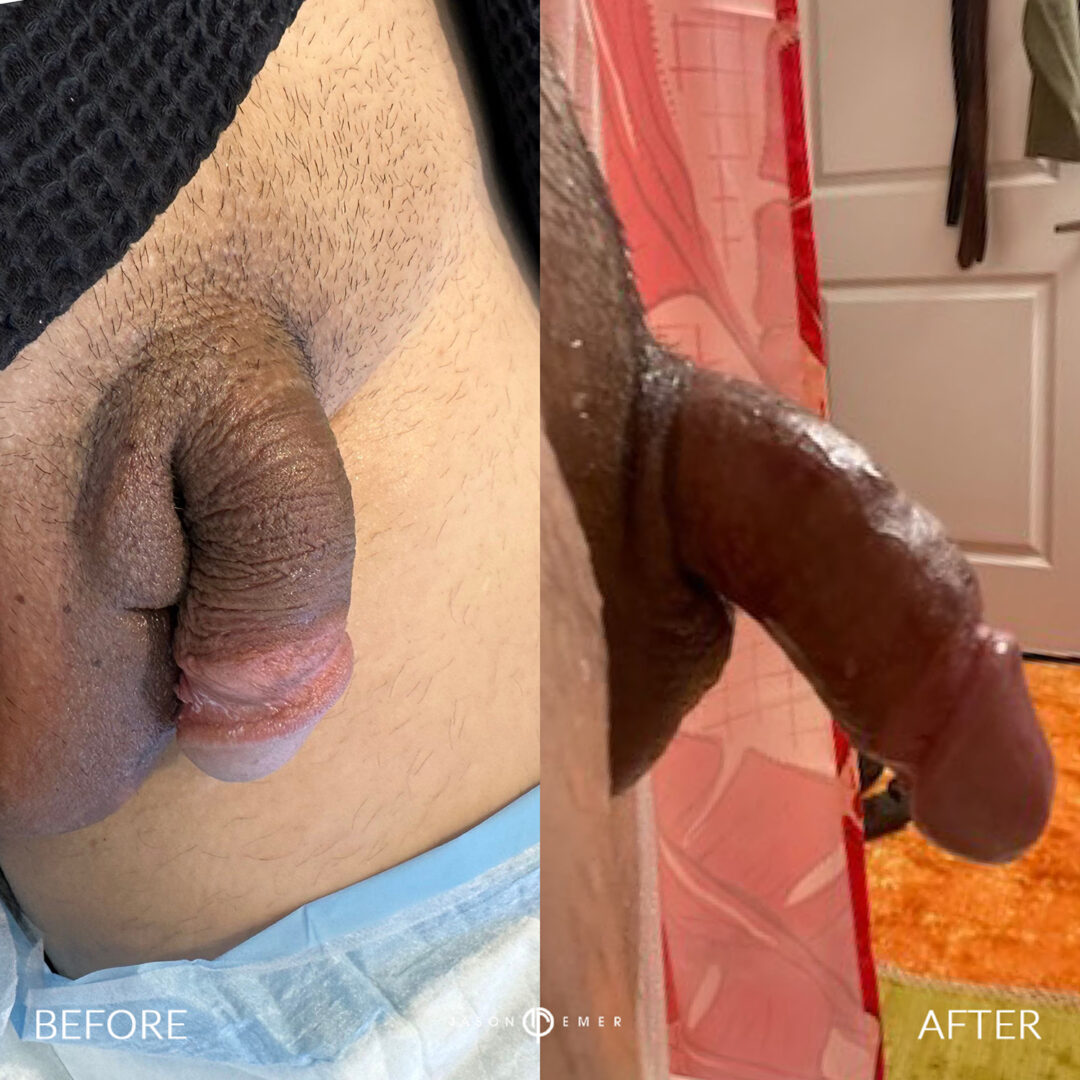 Penile Filler Before and After Photo by Dr. Emer in West Hollywood California